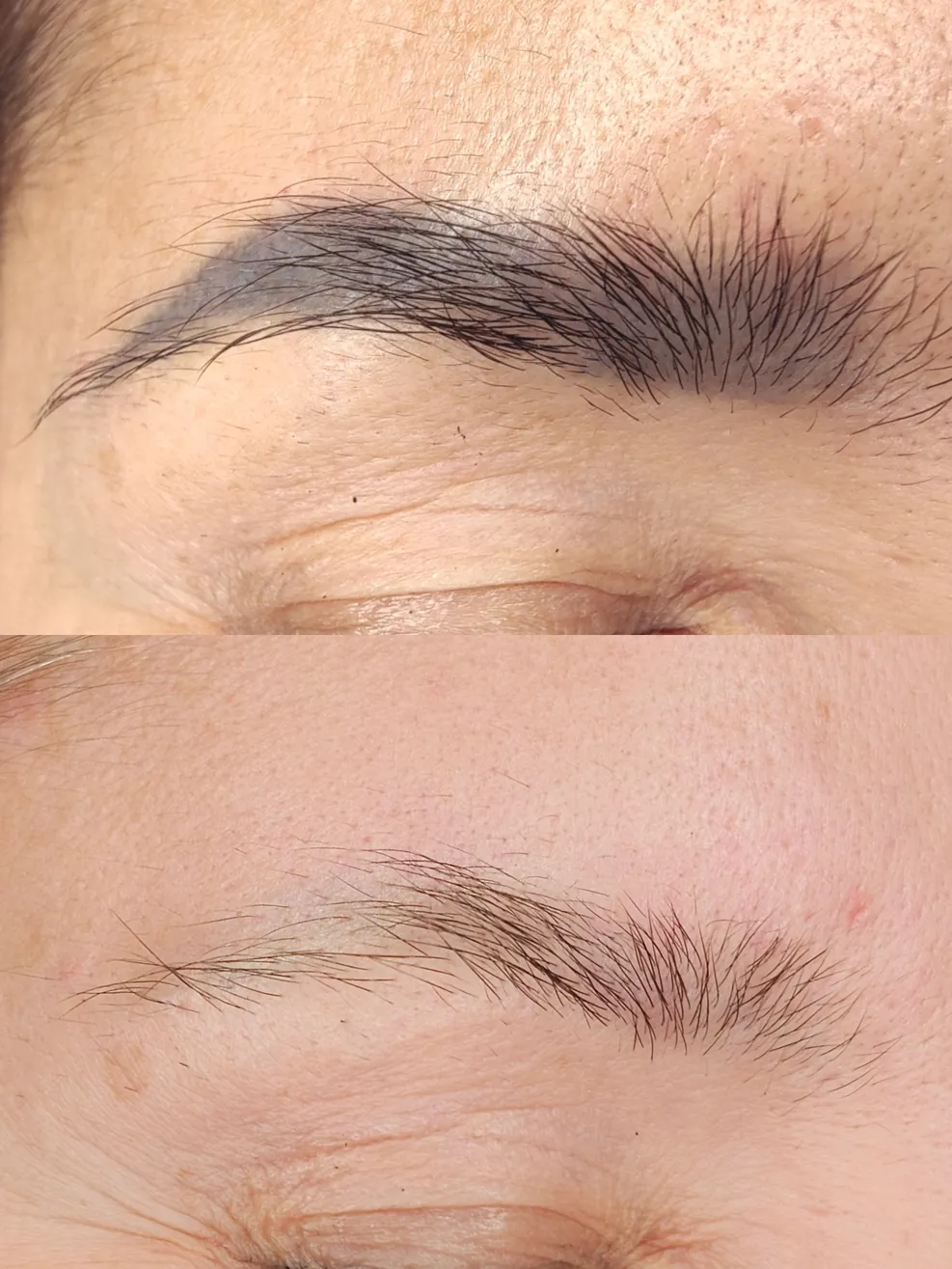 tattoo_removal