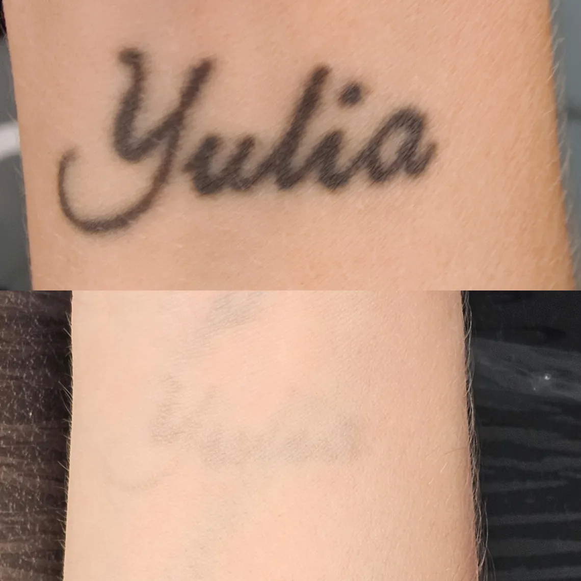 tattoo_removal