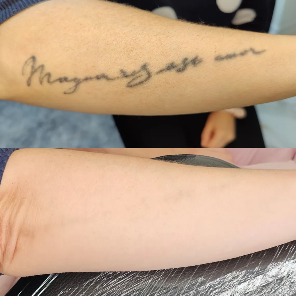 tattoo_removal