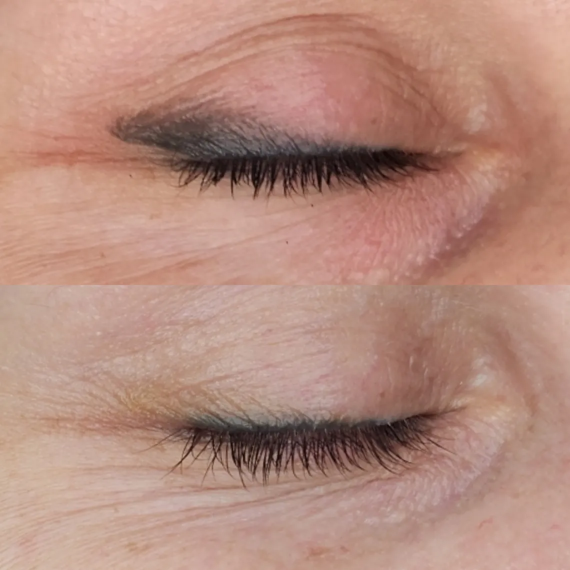 tattoo_removal